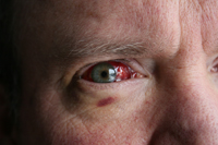 Eye hemorrhage thumb 2