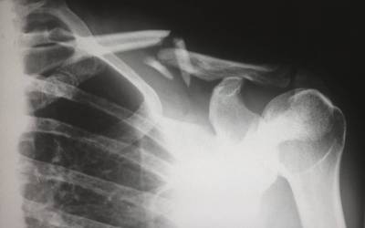 Personal Injury and Other Negligent or Intentional Torts